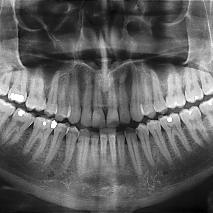 X-Ray of teeth